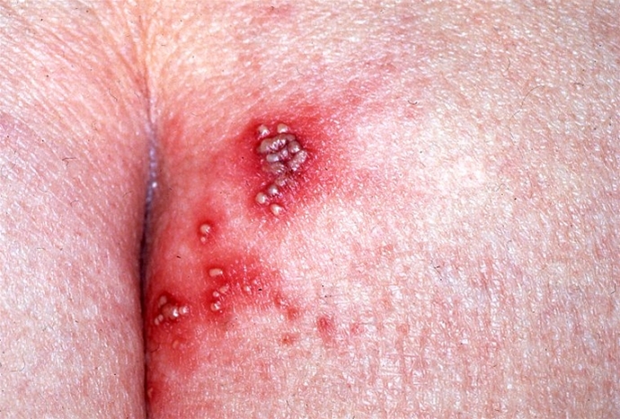 Genital herpes with vesiko-pustular rash on the bales