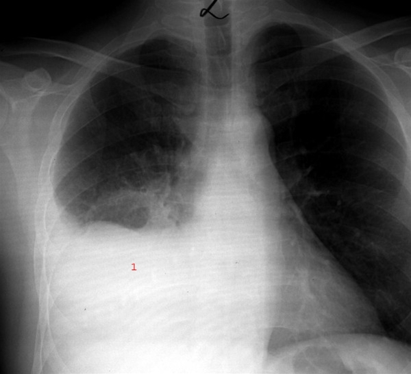 X-ray of pneumonia, lower portion of the right lung