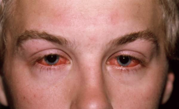 Photo of man with conjunctivitis