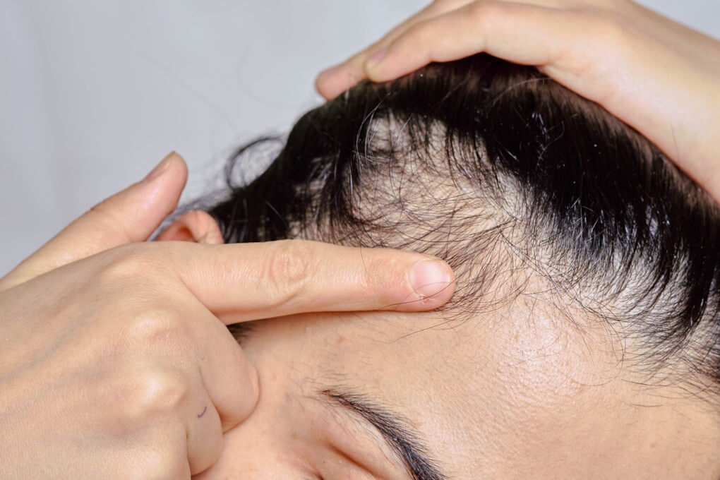 Do You Struggle With a Dry Scalp? Everything You Need To Know To Treat